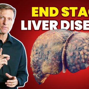 10 Signs of a Dying Liver  (End Stage Liver Disease)