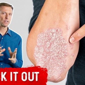 A Great Psoriasis Remedy