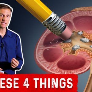 Preventing High Oxalate Kidney Stones