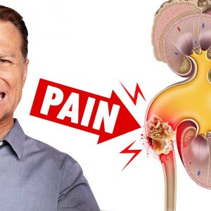 My INSANELY Painful Kidney Stone - Dr. Berg