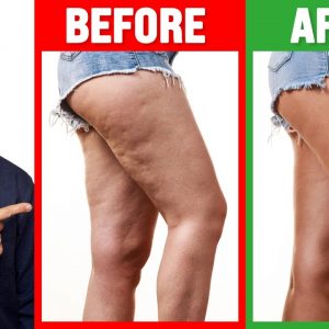 How to Lose Cellulite on Your Hips, Thighs and Buttocks: UPDATED - Dr. Berg