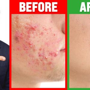 The FASTEST Way to Rid Acne - Dr. Berg