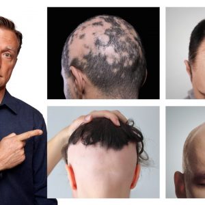 The 11 Types of Alopecia (AND HOW TO FIX IT) - Dr. Berg