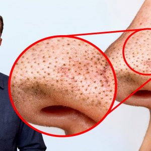 Remove Blackheads PERMANENTLY Simply by Tweaking Your DIET