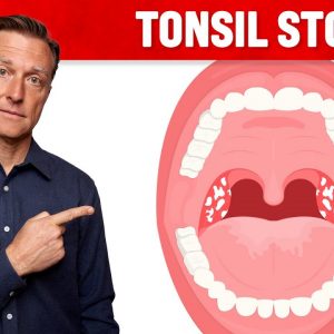 What CAUSES Tonsil Stones and How to Prevent Them