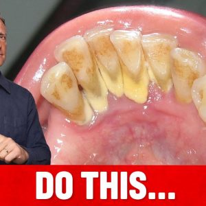 The #1 Top Remedy for Dental Plaque (TARTAR)