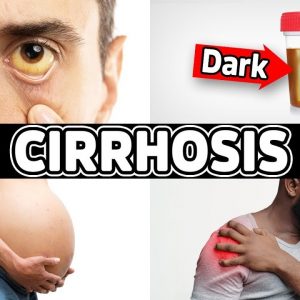 7 Warning Signs of Cirrhosis (End-Stage Liver Disease) - Dr. Berg