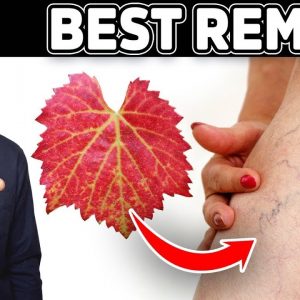 The #1 Remedy for Varicose Veins (Venous Insufficiency) - Dr. Berg
