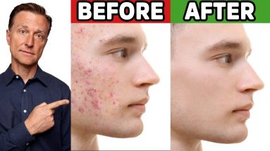 The Best Trick for Clear Skin (Acne, Aging, Wrinkles, Liver Spots)