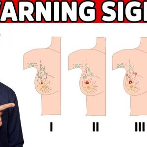 6 Early Warning Signs of Breast Cancer
