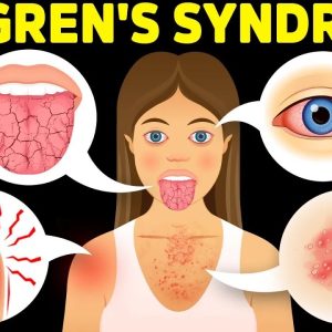 The Best Protocol for Sjogren's Syndrome