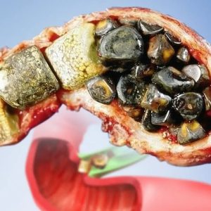 The FIRST Sign of Gallstones over 80% of the Time