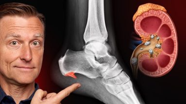 6 Reasons for Calcium Deposits (Spurs, Osteophytes, Stones, and Tartar)