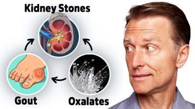 The Connection between Oxalates, Gout, and Kidney Stones