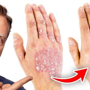The #1 Best Remedy for Eczema
