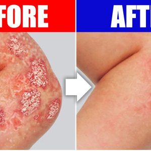 The #1 Remedy for Psoriasis