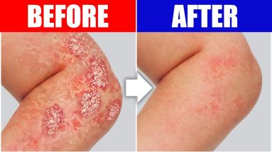 The #1 Remedy for Psoriasis