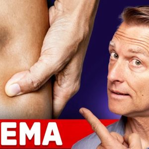 The 8 Causes of Edema