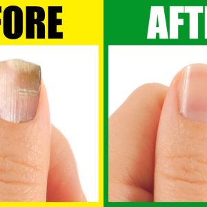 The Deeper Causes of Brittle Nails