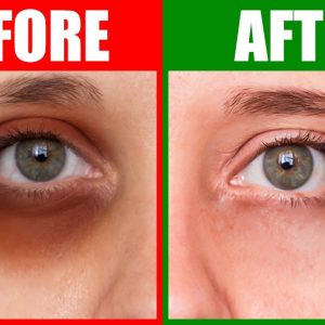 How To Rid Dark Circles Naturally in 24 Hours