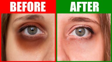How To Rid Dark Circles Naturally in 24 Hours