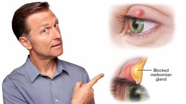 What Really Causes Styes and How to Get Rid of Them Fast