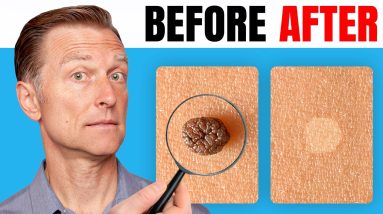 How to Remove Skin Tags and Warts Overnight - Dr. Berg Explains