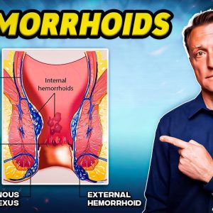 The #1 Best Remedy for Hemorrhoids - Dr. Berg