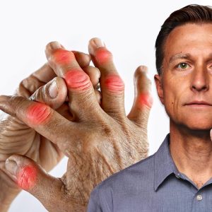 The #1 Best Vitamin for Arthritis (NOT VITAMIN D)