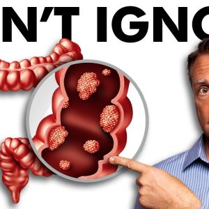 The Early Signs of Colon Cancer You DON'T Want to Ignore