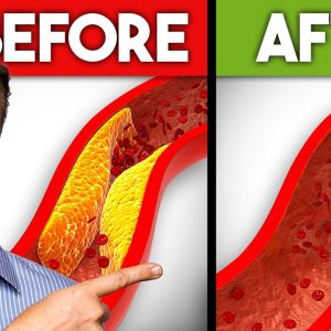 The Best Nutrients to Remove Plaque from Your Arteries