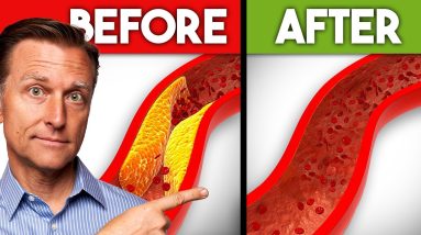 The Best Nutrients to Remove Plaque from Your Arteries