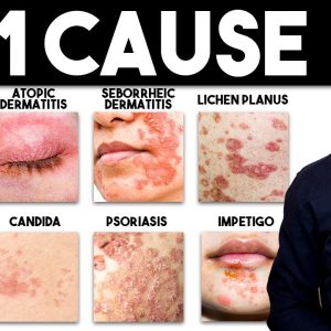 The MOST Common Deficiency in All Skin Diseases (Dermatitis)